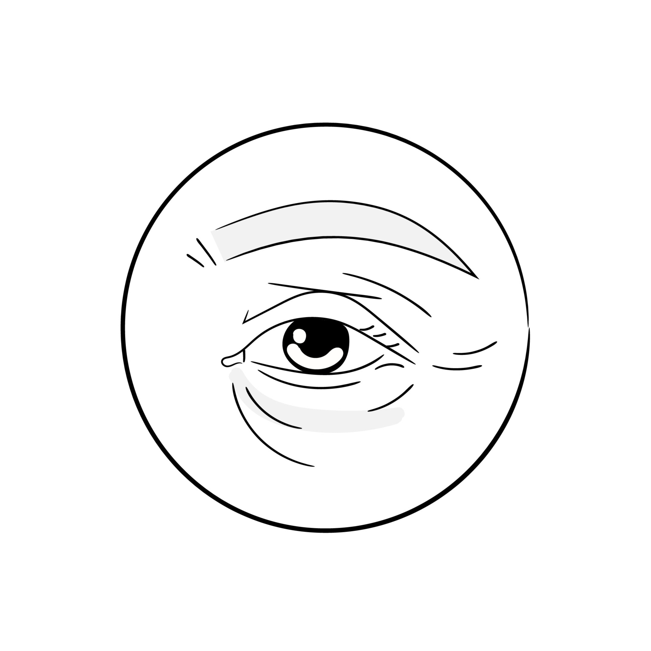 Illustration of a puffy, irritated eye—common symptom of chronic dry eye