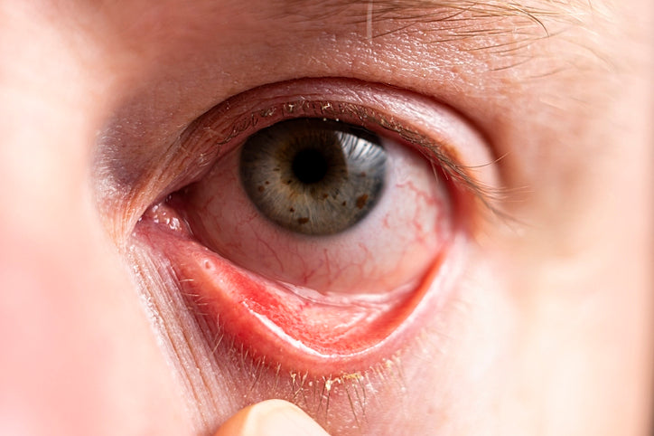 dry eye