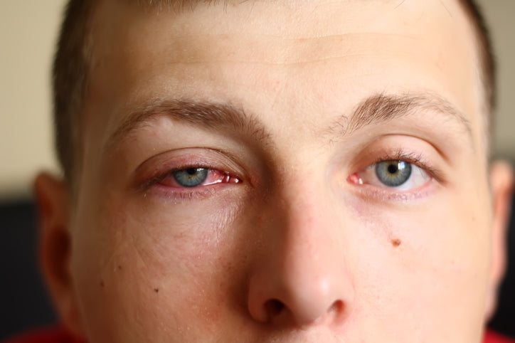 dry eye
