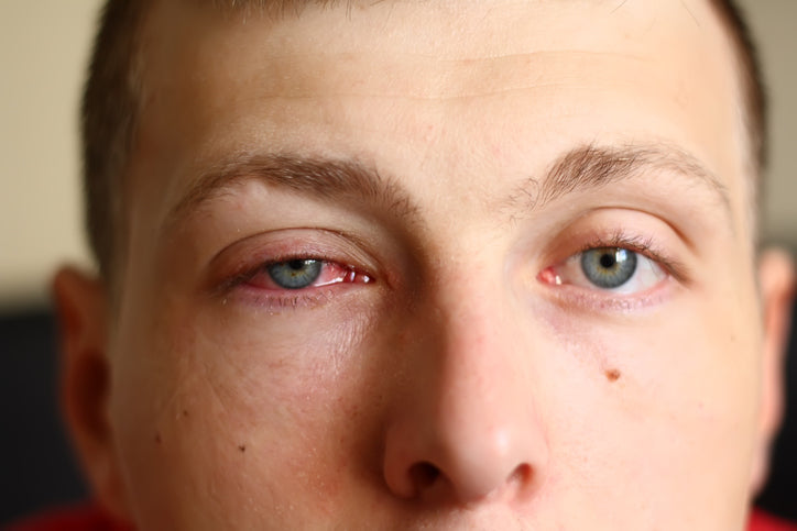 dry eye
