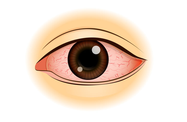 dry eyes
