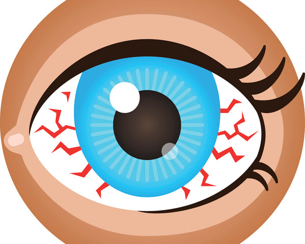 dry eye