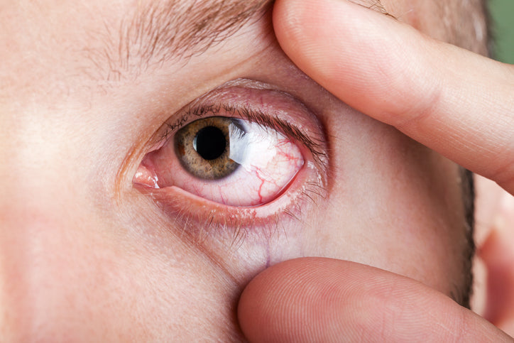 dry eyes
