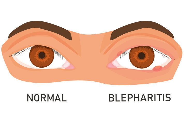 blepharitis