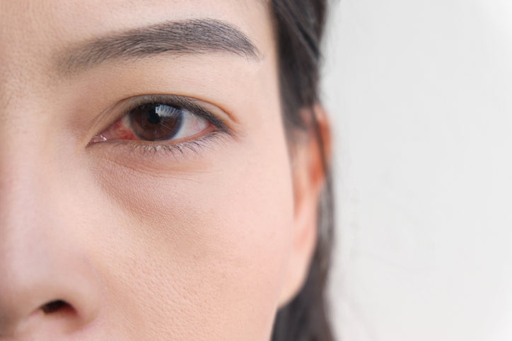 dry eye