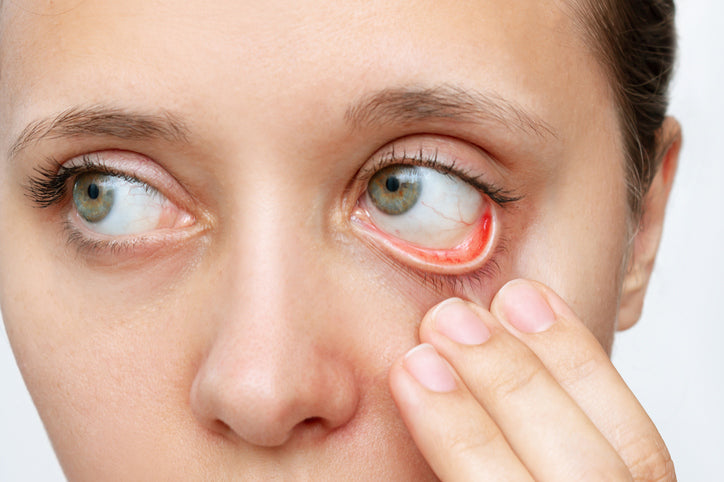 dry eyes