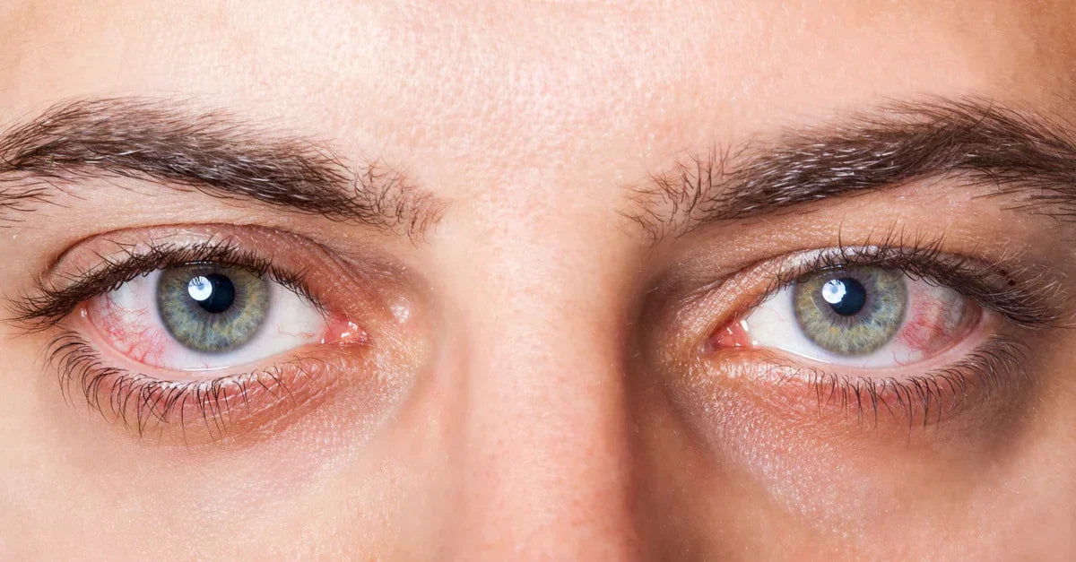 Male irritated eyes close up