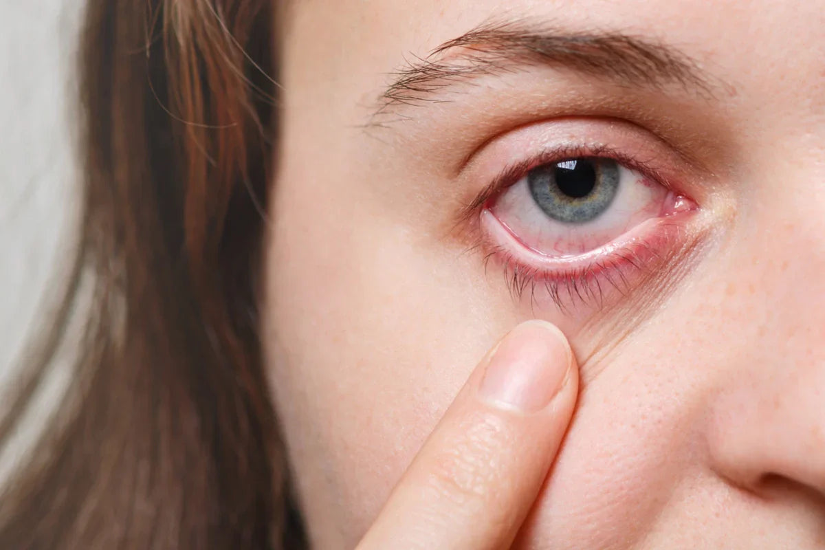 What is Blepharitis?
