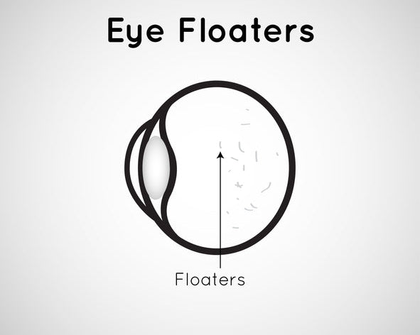 Eye Care 101 - Will Dry Eyes Lead to Vitreous Detachment – Wizard Heated Eye Mask Blog
