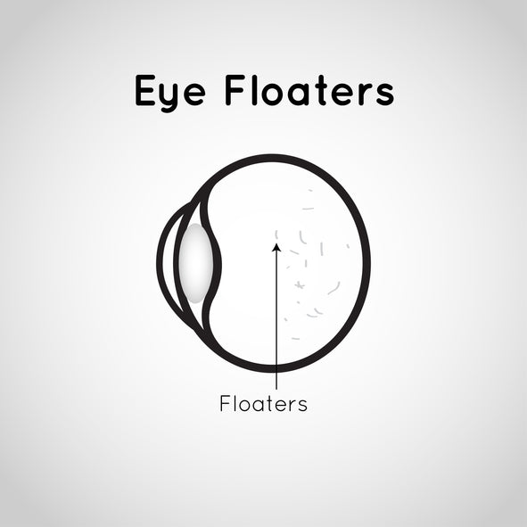 Eye Care 101 - Will Dry Eyes Lead to Vitreous Detachment – Wizard Heated Eye Mask Blog
