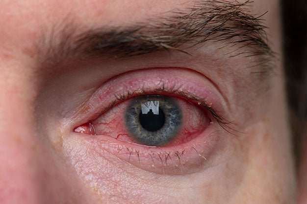 How To Soothe Irritated Skin Around Your Eyes | Full Guide – Wizard Heated Eye Mask Blog