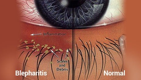 What is Eyelid Hygeine? – Wizard Heated Eye Mask Blog